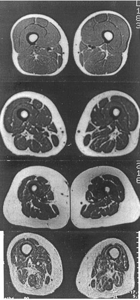 SARCOPENIC OBESITY Excess body fat + Muscle atrophy