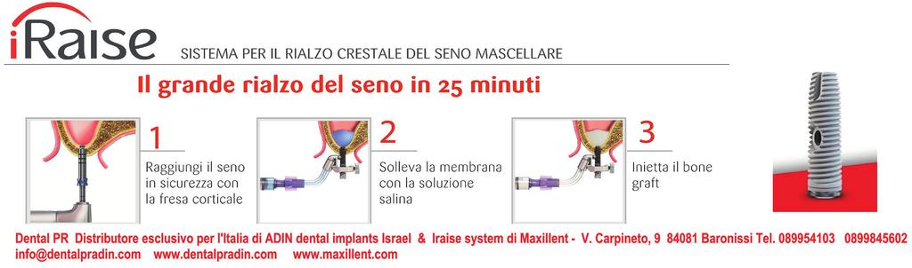 APPROFONDIMENTI Logico 3D & ELOS Flusso digitale con componentistica implantare LOGICO 3D è uno scanner ottico a luce strutturata semplice, veloce, ad alte prestazioni ed economico progettato da