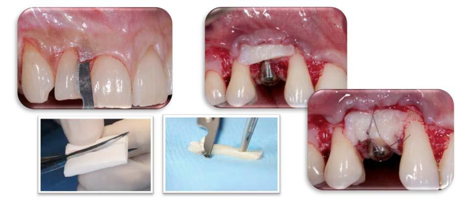 La gestione dei tessuti molli in implantologia: tecniche di chirurgia plastica parodontale applicati alla chirurgia implantare.