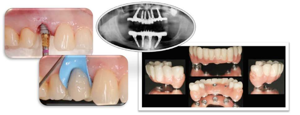 Il carico immediato nei pazienti parzialmente e totalmente edentuli VideoCorso teorico con relive surgery Tiziano Testori Obiettivi didattici/clinici - indicazioni e controindicazioni cliniche al