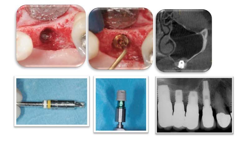 L elevazione del seno mascellare: approccio crestale e le alternative chirurgiche (impianti corti ed angolati) VideoCorso teorico con relive surgery Tiziano Testori Obiettivi didattici/clinici