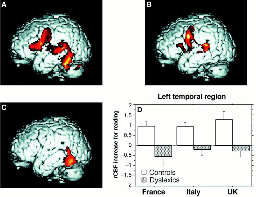 Figure 3 Brain areas activated in normal and dyslexic readers from three countries: United Kingdom, France, and Italy.