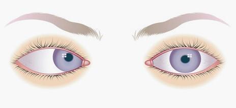 - esoforia: gli occhi convergono verso l interno e gli assi visivi si incontrano prima del punto di fissazione; Esoforia: un occhio devia verso l'interno - exoforia: gli occhi