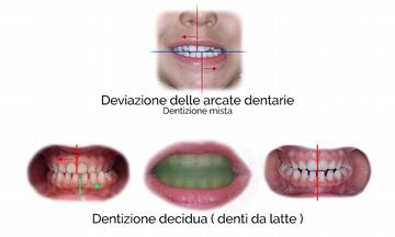 Il sistema è particolarmente valido in quanto: non prevede estrazioni di denti sani quando sono presenti affollamenti dentari in arcata; attraverso la risoluzione delle cause determinanti delle mal