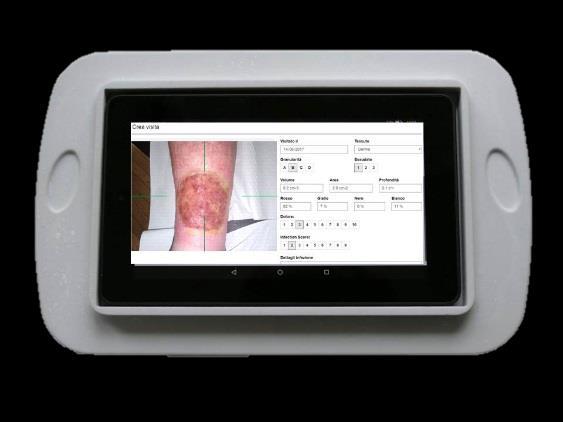 riconoscimento della composizione del tessuto dell ulcera (ad es.