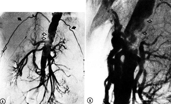 Fig. 1 Journal of Vascular Surgery 1984 1, 903-909DOI: (10.
