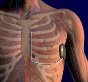 ICD SOTTOCUTANEO (S-ICD) Il sistema è completamente esterno al sistema venoso ed alla gabbia toracica IN