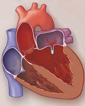 RISULTATI Analisi dei potenziali predittori di outcome clinico Ventricolo DESTRO NESSUN responder presentava disfunzione ventricolare destra alla valutazione emodinamica La mrap elevata si associa ad