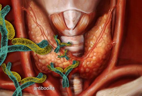 Autoimmunità )roidea AnIcorpi ani- TPO e ani- Tg si repertano nel 10-20% delle donne in età ferile (ThangaraInam et al.