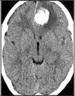 Figura 4 TC cranio: emorragia cerebrale La TC evidenzia l emorragia ma non permette di diagnosticare la malformazione vascolare, che deve essere ricercata con esami mirati.