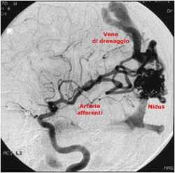 Figura 5 RM: un aggregato di vasi tortuosi, dilatati, suggerisce la presenza di una MAV. Come nel caso degli aneurismi cerebrali, l esame diagnostico di scelta è l angiografia cerebrale.