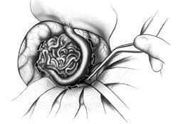 Figura 6 Aspetto angiografico di una MAV: chiara visualizzazione delle arterie afferenti, del nidus e delle vene di drenaggio.