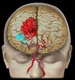 Trattamento endovascolare Il trattamento endovascolare ha l obiettivo interrompere la comunicazione artero-venosa mediante l iniezione di materiale embolizzante (sostanze acriliche) all interno del