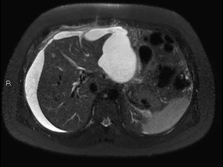 Colangiografia intraoperatoria vs