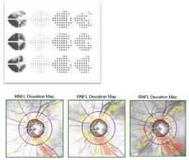 Anno sedicesimo marzo 2011 118 fig. 5 Esempio di progressione analizzata mediante un analisi del trend del visual field index (VFI) con previsione a 5 anni dello stato funzionale del campo visivo.