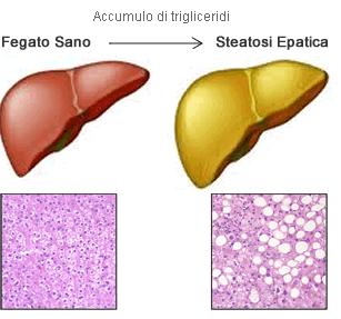 La steatosi deriva da: eccesso di NADH-H+ prodotto nel metabolismo dell alcool che permette shunt di substrati verso la biosintesi di