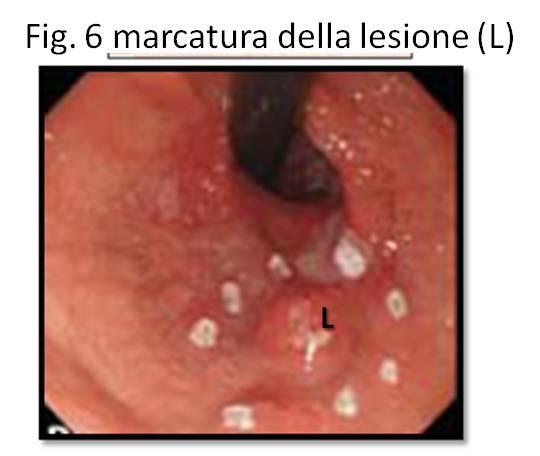 LA MUSECTOMIA ENDOSCOPICA Introdotta a metà circa degli anni 90 in Giappone, la mucosectomia nasce come una metodica dedicata alla asportazione di neoplasie del tubo digerente localizzate negli stadi