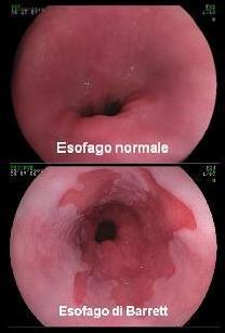 più lingue o chiazze di mucosa vellutata rossa, che si estendono al di sopra della giunzione gastro-esofagea, definita dall apice delle pliche gastriche.