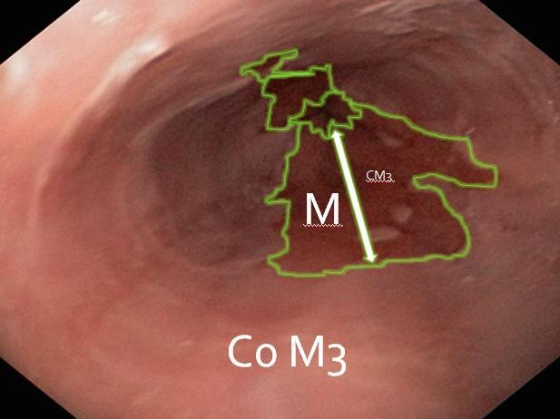 , ha reso possibile la classificazione endoscopica dell esofago di Barrett, introducendo il criterio C, cioè la massima estensione circonferenziale, espressa in centimetri, a partire dalla giunzione