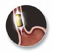 Modalità d uso (fig.11) L ablazione con radiofrequenza è un intervento chirurgico effettuato in sedo analgesia profonda.