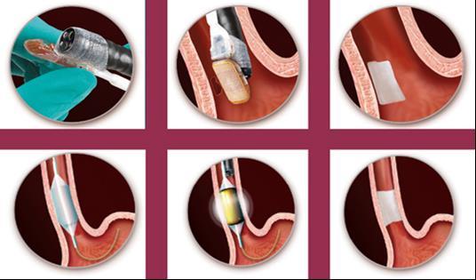 (fig.11.) Trattamento endoscopico con RFA nei vari tipi di Barrett. Quando è controindicata e Quali sono le più importanti avvertenze?