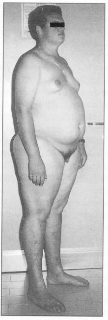 Sindrome di Klinefelter (47,XXY) Non-disgiunzione (50% paterna). Frequenza alla nascita di ~1:1000 maschi.