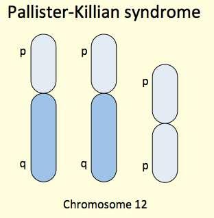 Pallister-Killiam syndrome tetrasomia 12p da i(12p) Sindrome rara con anomalie congenite multiple e ritardo mentale (circa 1/25.000).