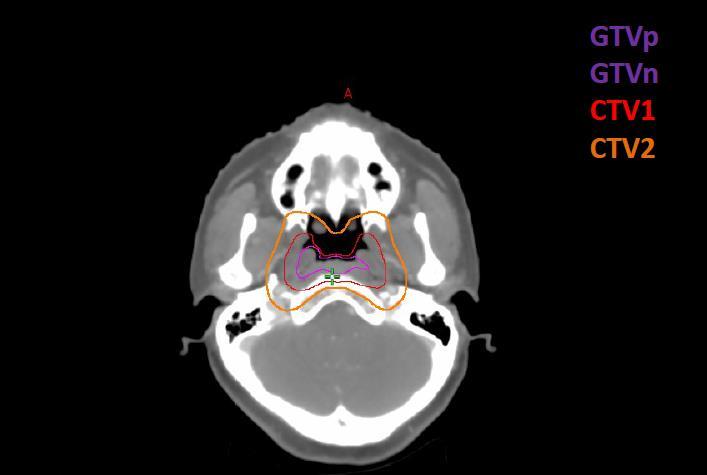 Alcune considerazione riguardo il GTVp (tumore primitivo) Richiede la sintesi di dati clinici e d'imaging raccolti durante la procedura di diagnosi-stadiazione.