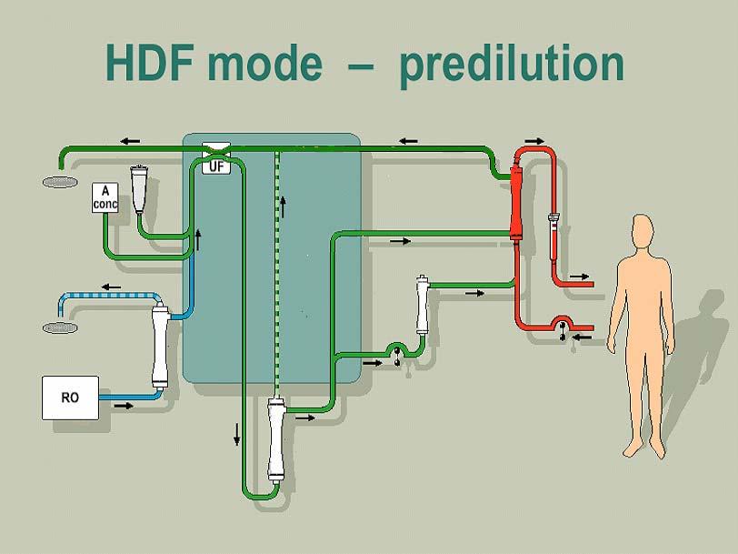 HDF On-Line in pre-diluizione U 2000 U 8000 S Infusione