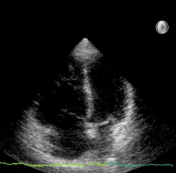 All ecocardiogramma Ipertrofia eccentrica del ventricolo sinistro Segni doppler da alterato rilasciamento del ventricolo sinistro
