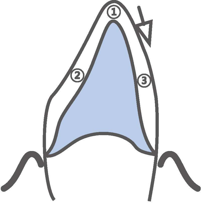 Preparazione del dente Scansione e progettazione A.