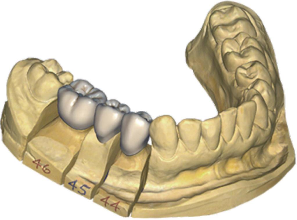 Per evitare fratture, assicurare un minimo di 0,8 mm di spessore linguale e un minimo