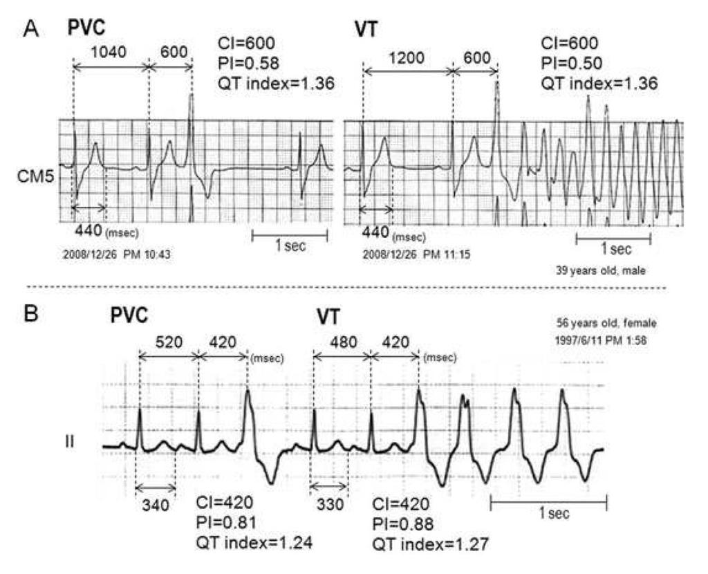 Extrasistoli ventricolari idiopatiche maligne. A prematurity index 0.