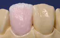 1. Cottura dentina / incisal Effettuare la stratificazione secondo lo schema di stratificazione (vedi