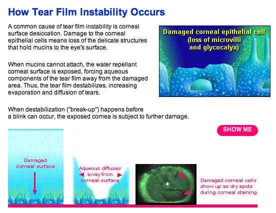 Sindrome dell occhio secco Una conseguenza comune dell instabilità del film lacrimale è l essicazione della superficie della cornea.