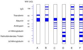 Esempio di elettroforesi delle proteine urinarie mediante SDS-PAGE