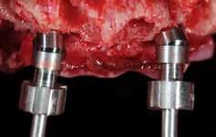 raggiungendo un elevato valore di stabilità primaria sfruttando l osso residuo del paziente, l inclinazione delle fixture e gli eventuali