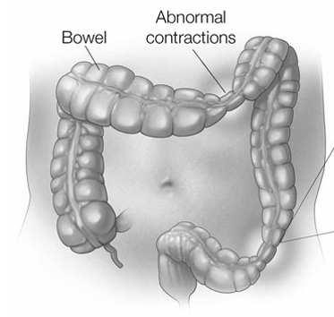 IBS: effetti dei probiotici Ford AC. Am. J. Gastroenterol.