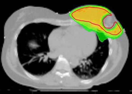 Radioterapia Whole Breast