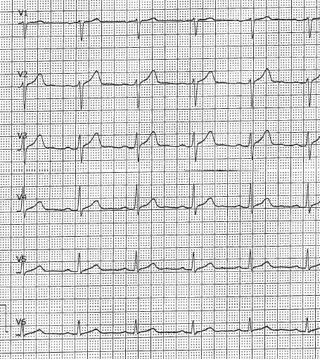 paziente riesce ad affiancare il mezzo, con danni limitati e senza traumi, e a coricarsi nel sedile