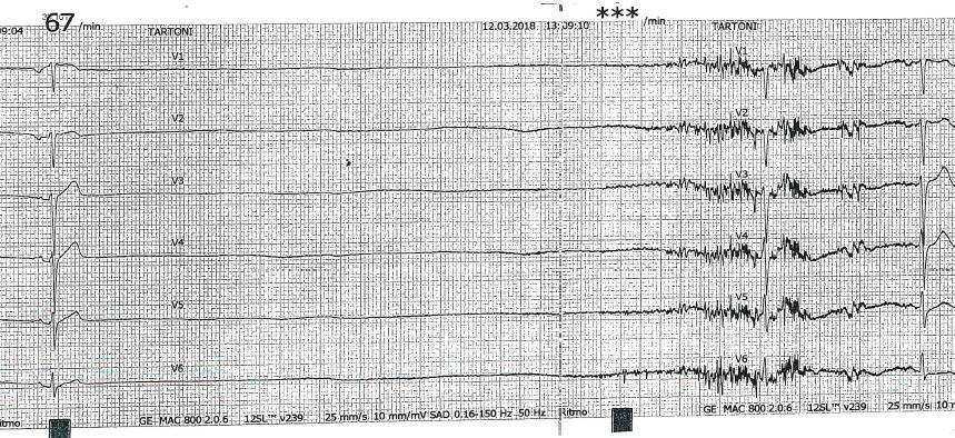 ricovero in Medicina d'urgenza: esecuzione di massaggio del seno carotideo, risultato negativo, e di TILT TEST, risultato positivo per sincope riflessa