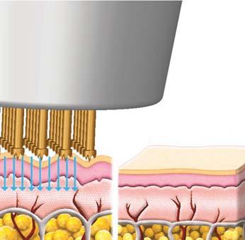 Le testine FPC innescano reazioni rigenerative nei tessuti di sostegno, determinando un rimodellamento delle fibre collagene con aumento della loro forza tensile e stimolazione della fase