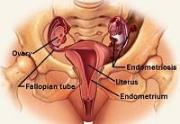 L'esatta prevalenza dell'endometriosi è sconosciuta, ma si stima che in Italia siano affette da questa malattia il 2-10% delle donne, con un picco di incidenza tra i 25 e i 35 anni, ma la