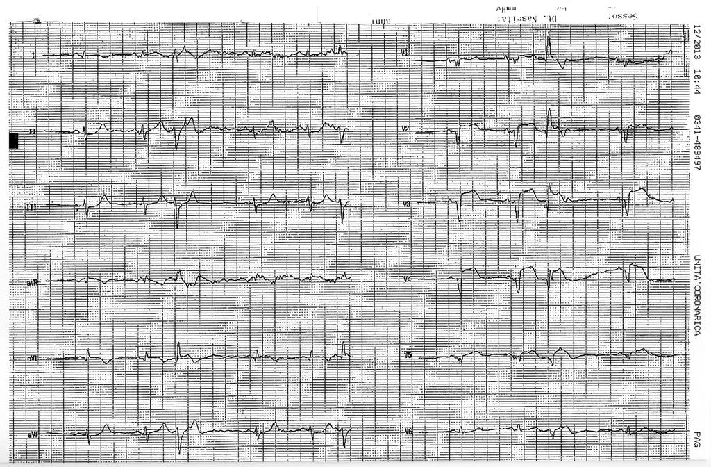 Il paziente è giunto asintomatico ed emodinamicamente stabile al Centro di III livello; per questa ragione è stata eseguita una coronarografia tre giorni dopo, che ha evidenziato riperfusione del
