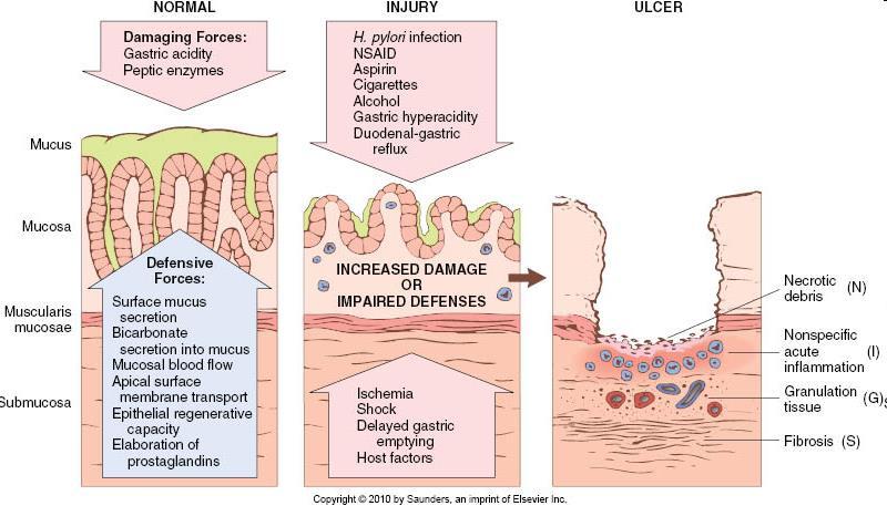 gastriti acute Clinica Dolore Perforazione Emorragie Esito variabile Etiopatogenesi Alterazione della protezione della mucosa Riduzione sintesi mucina Fattori fisici Fattori tossici Fattori iatrogeni