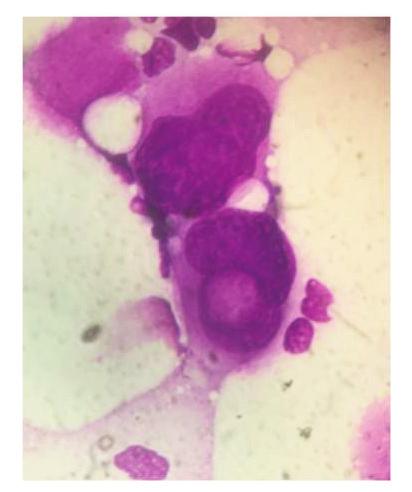 Sono considerati displastici i megacariociti con nuclei separati (bi-nucleati o plurinucleati), i megacariociti con nuclei monolobati e ipolobati e i micromegacariociti.