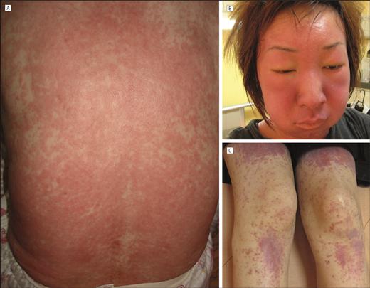 Drug related Eosinophilia with Systemic Symptoms DRESS - Esantema maculare - Eritema /angioedema