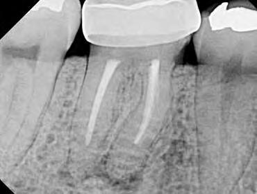 Richard Mounce, DDS L ottenimento della pervietà canalare nei ritrattamenti endodontici Fig. 1 a b. Pre e post-operatoria di un molare con canali intasati e con gradini, dopo il loro ritrattamento.