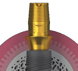 le peri-implantiti Limita il riassorbimento osseo peri-implantare 2 Profilo d emergenza