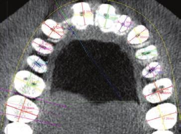 UN VERO PROFILO DI EMERGENZA ANATOMICO Il diametro di un impianto non corrisponde alla sezione anatomica trasversale del dente da sostituire.